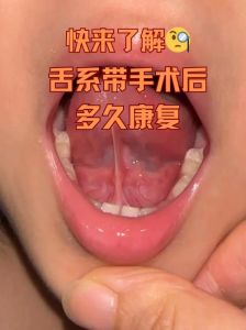 舌系带断了怎么办图片，宝宝舌系带短，别急着剪，观察等待是关键